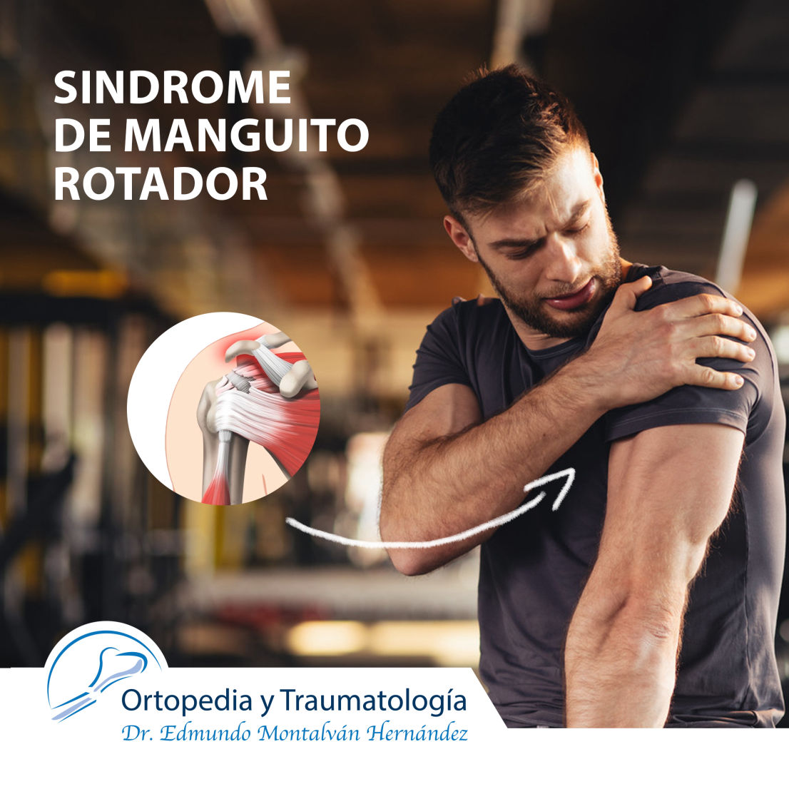 Tratamiento del síndrome de manguito rotador