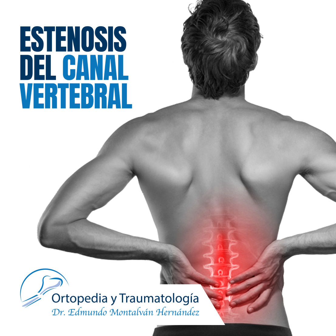 Estenosis del conducto vertebral