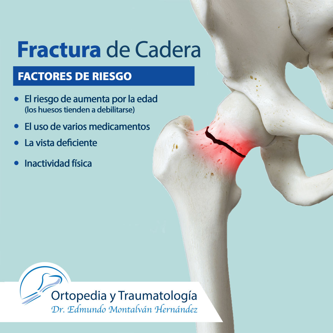 Fractura de cadera en Chilpancingo