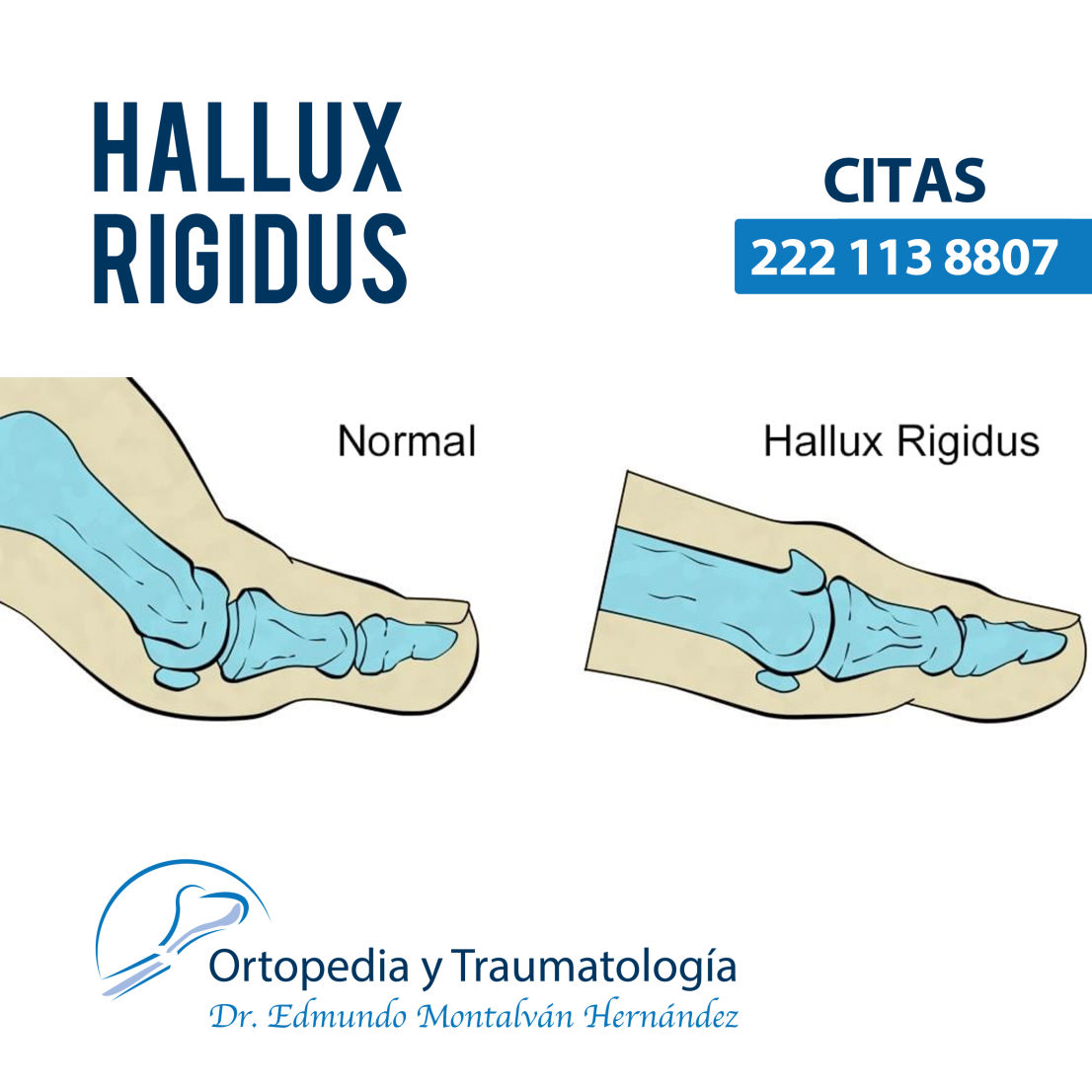 Tratamiento de Hallux Rigidus en Chilpancingo