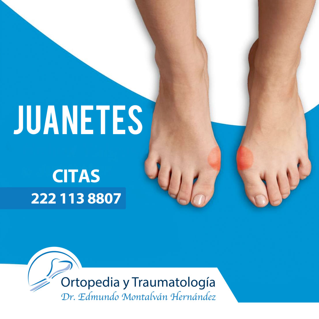 Tratamiento de Juanetes en Chilpancingo