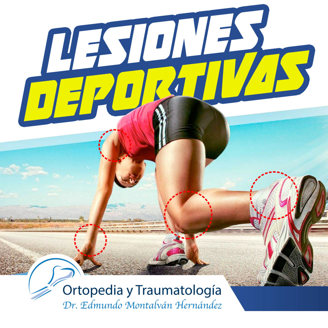 Tratamiento de Lesiones deportivas en Chilpancingo