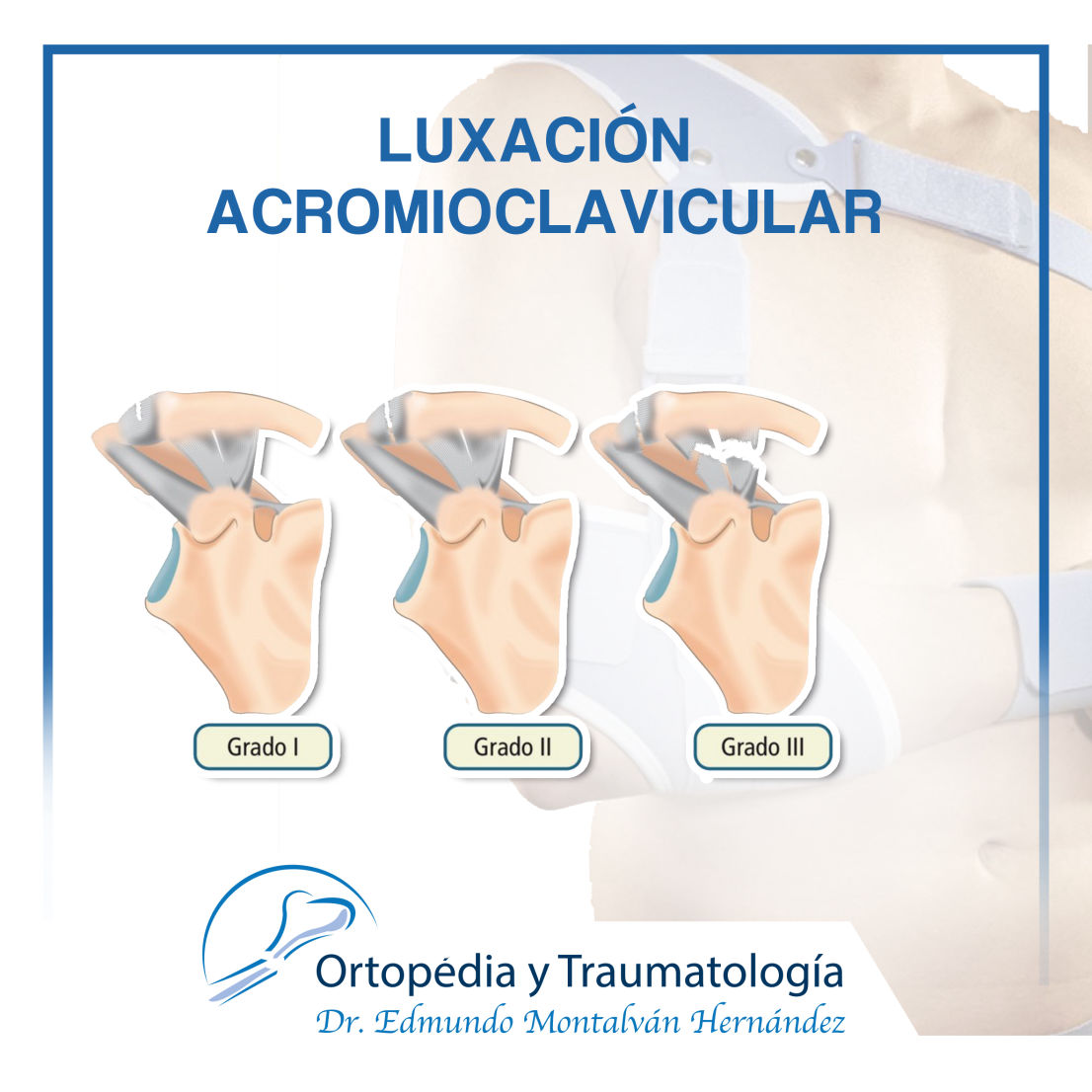 Luxación acromioclavicular