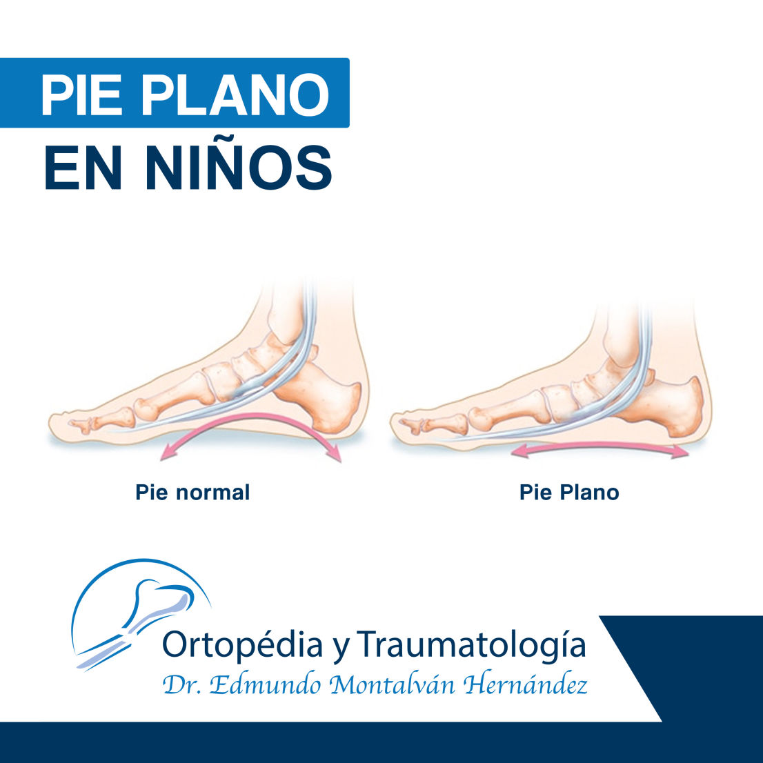 Tratamiento de Pie plano en Chilpancingo