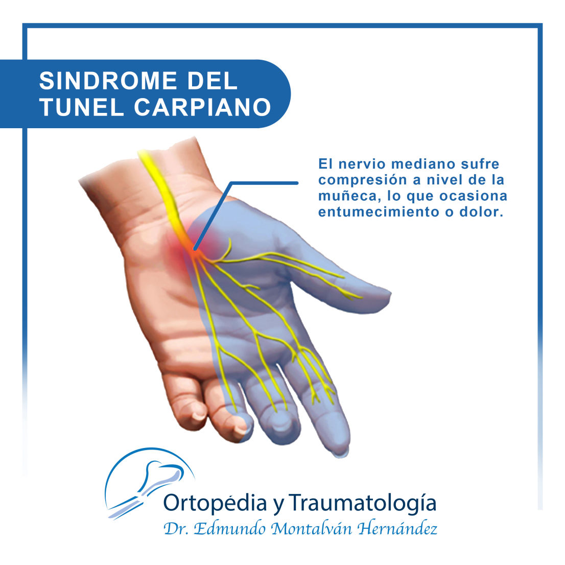 Tratamiento del Síndrome del túnel carpiano